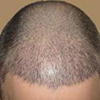 علل ریزش موی سر که باید مورد بررسی قرار گیرد