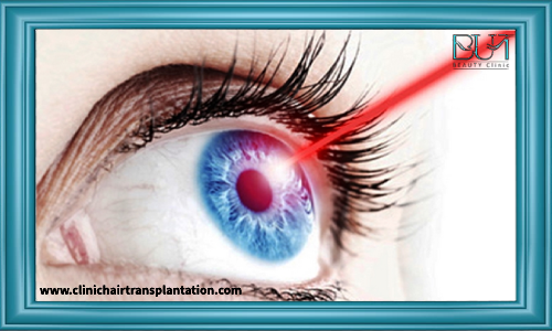 شرایط مناسب برای انجام جراحی لیزیک چشم