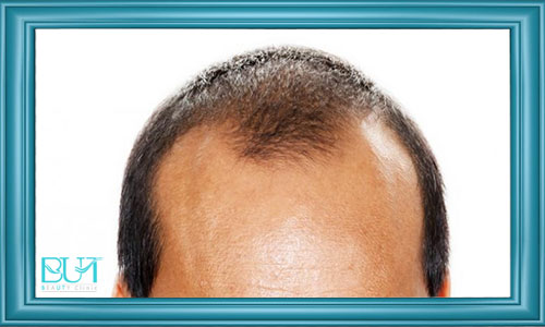 عوامل تاثیر گذار بر طبیعی شدن خط مو در کاشت مو