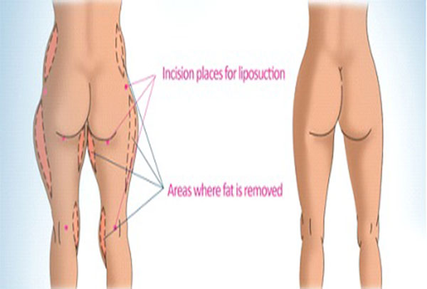 دانستنی هایی درباره لیپوساکشن شکم و پهلو