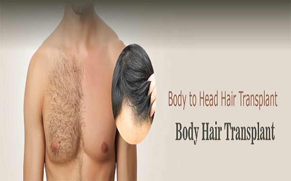 کاشت مو به روش BHT-کلینیک کاشت مو