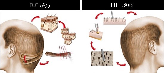 ترمیم مو