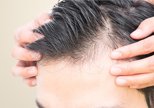 Hair transplantation-rozclinic