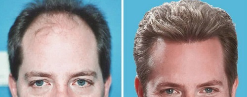 Hair-transplantation-clinic