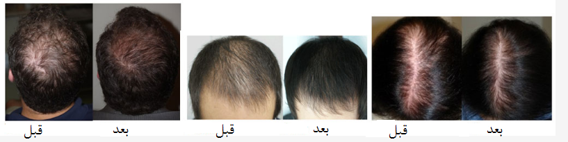 کاشت مو به روش PRP