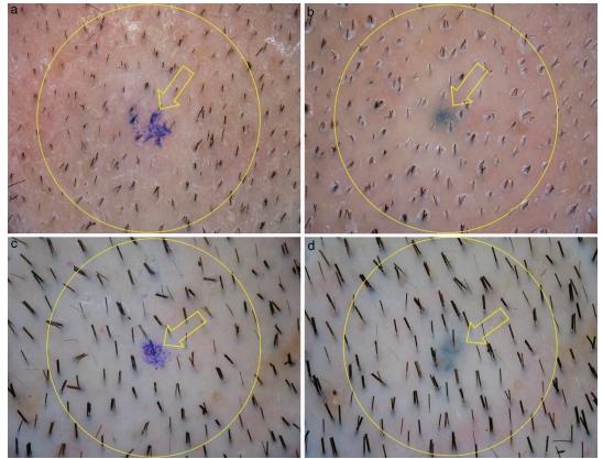 نقش سلول های بنیادی در کاشت مو چیست؟