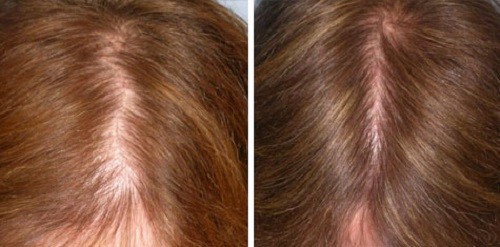 آیا زنان هم می‌توانند موی طبیعی بکارند؟