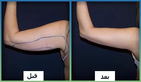 آیا لیپوماتیک تکنولوژی جدیدی است؟