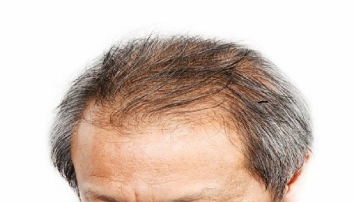 خطرات و عوارض کاشت مو را بشناسید