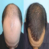 مزایای کاشت مو به روش PRP