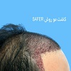 چگونگی کاشت موی طبیعی به روش safer