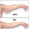 لیپوماتیک بازو مناسب چه افرادی است