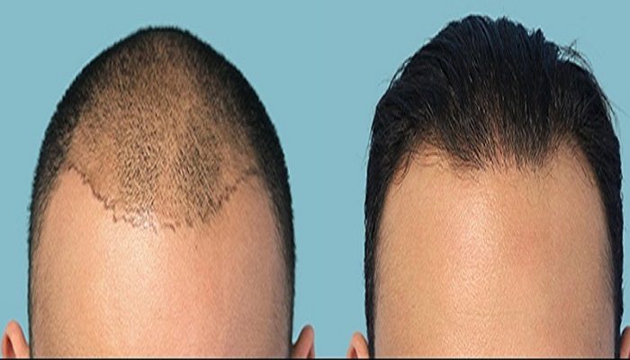 چگونگی کاشت مو به روش FUT