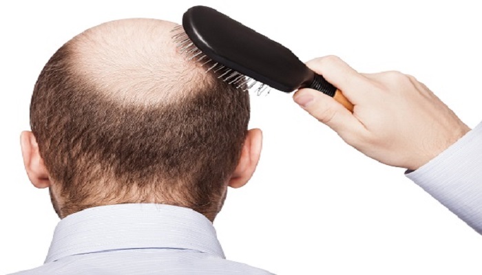 عوارض بعد از کاشت مو چیست؟