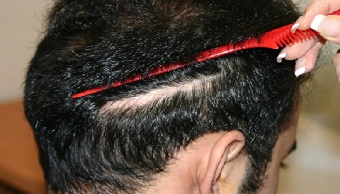 فیناستراید داروی درمان ریزش مو (Finasteride)