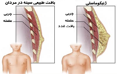 کوچک کردن سینه در مردان (ژینکو ماستی)