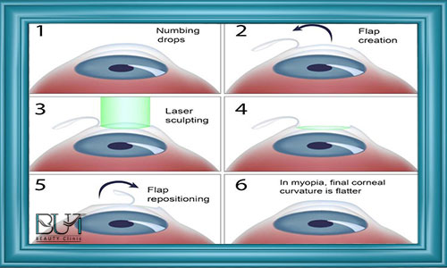 نحوه انجام جراحی لیزیک چشم