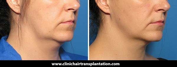 تاثیر لیپوماتیک بر جوانسازی صورت _ کلینیک