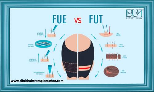 مقایسه کاشت مو به روش FUT  و FIT