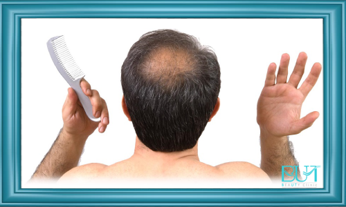 درمان ریزش مو با کاهش مصرف مواد شیمیایی