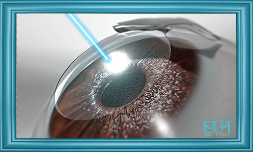 عوارضی که عمل لیزیک چشم به همراه دارد