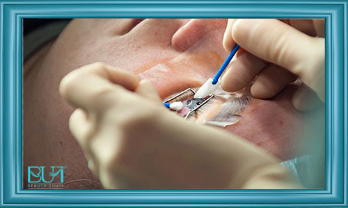 مزایا، معایب و عوارضی عمل جراحی لیزیک چشم