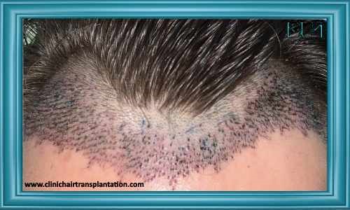 انواع ورم بعد از کاشت مو﻿﻿