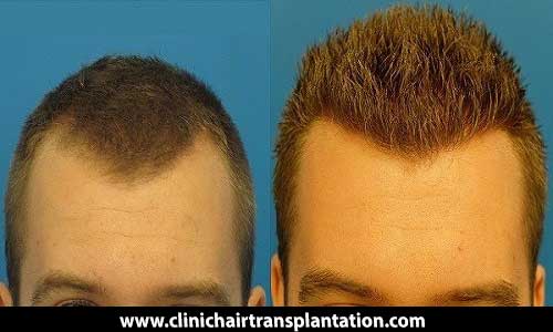 تغییر حجم مو بعد از کاشت مو _ کلینیک