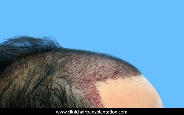 کاشت مو به روش safer برای جلوی مو _ کلینیک
